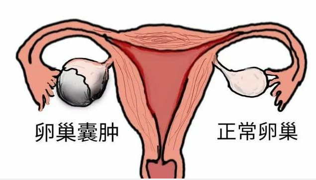 早知道卵巢囊肿有这么多有效方法，还有谁会去做手术！