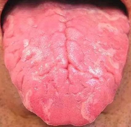 舌头中间有裂纹，或者边缘有齿痕等，是『大病征兆』？现在知道还不晚!